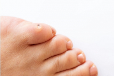 Can Corns on the Feet Become Serious Problems?