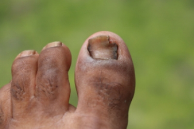 Early Detection of Toenail Fungus