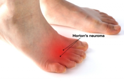 Understanding Morton’s Neuroma