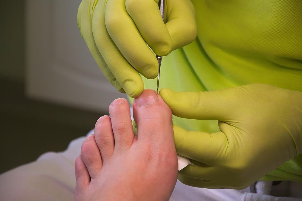 Ingrown Toenails  Hatfield, MA , 
