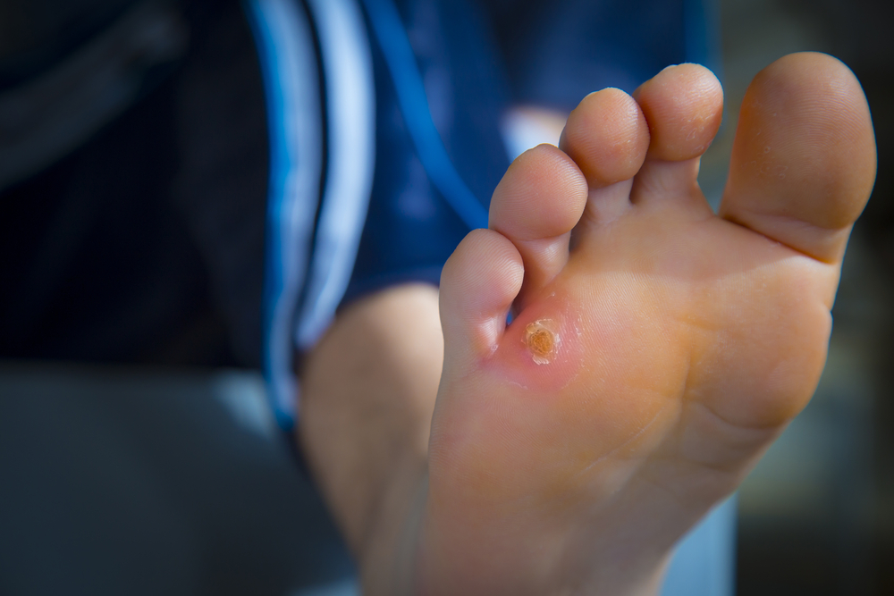 Wound Care  Hatfield, MA , 